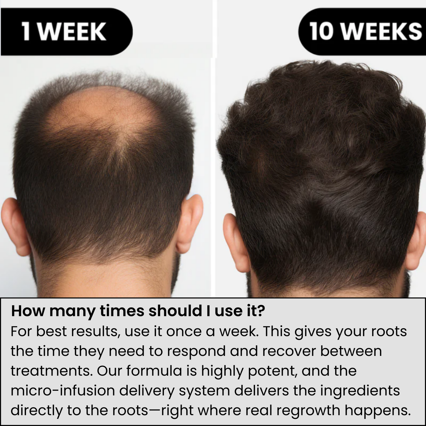 InfusionLabs™ Hair Regrowth System